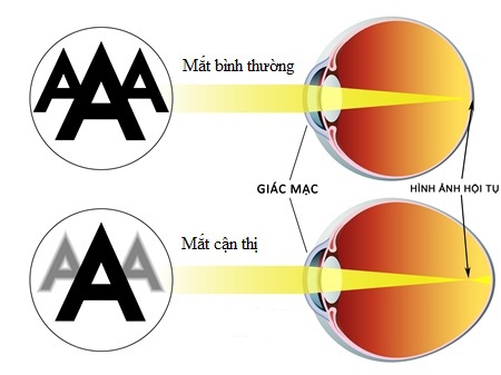 cac-phuong-phap-dieu-tri-can-thi
