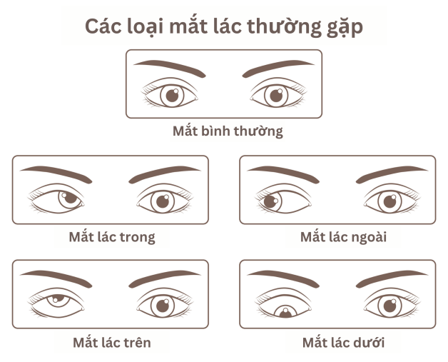lac-mat---nguyen-nhan-va-trieu-chung-nhan-biet