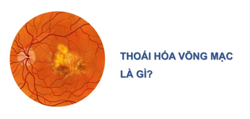 thoai-hoa-vong-mac-chu-bien-do-can-thi