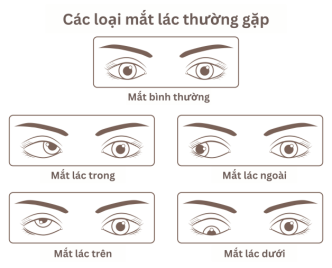 lac-mat---nguyen-nhan-va-trieu-chung-nhan-biet