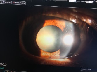 tu-a---z-ve-benh-duc-thuy-tinh-the