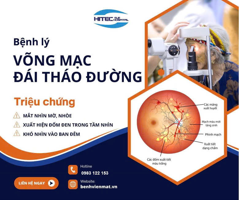 benh-ly-vong-mac-dai-thao-duong